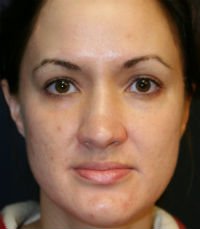 Rhinoplasty San Diego Case 24 - before - oblique