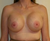 Breast Augmentation San Diego Case 49 - after