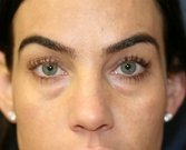 Lower Eyelid Radiesse San Diego - before