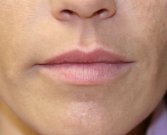 Lip Augmentation with Juvederm, San Diego - before