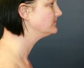 Liposuction Neck San Diego Case 10 - before