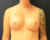 Breast Augmentation San Diego Case 50 - after