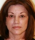 Browlift San Diego Case 10 - after