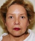 Browlift San Diego Case 12 - after