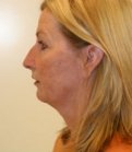 Necklift San Diego Case 13 - before