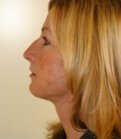Necklift San Diego Case 13 - after