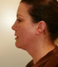 Neck Liposuction San Diego Case 16 - before