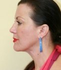 Neck Liposuction San Diego Case 16 - after