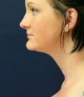 Neck Liposuction San Diego Case 17 - after