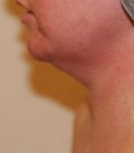 Neck Liposuction San Diego Case 18 - before