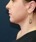 Neck Liposuction San Diego Case 18 - after