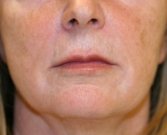 Lips San Diego Case 14 - before
