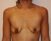 Breast Augmentation San Diego Case 51 - before