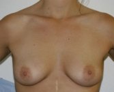 Breast Augmentation 34a - before