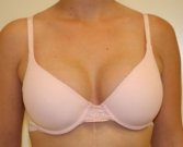 Breast Augmentation 34a - after