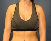 Breast Augmentation San Diego Case 53a - after