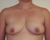 Breast Augmentation Case 5 - before