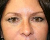 Eyelid Surgery San Diego Case 37 - after