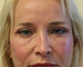 Eyelid Surgery San Diego Case 38 - before