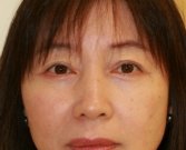 Eyelid Surgery San Diego Case 39 - after