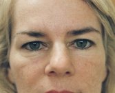 Eyelid Surgery San Diego Case 40 - before