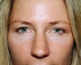 Eyelid Surgery San Diego Case 41 - after