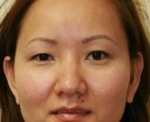 Eyelid Surgery San Diego Case 42 - before
