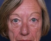 Eyelid Surgery San Diego Case 43 - before