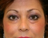 Eyelid Surgery San Diego Case 44 - before