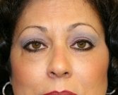 Eyelid Surgery San Diego Case 44 - after