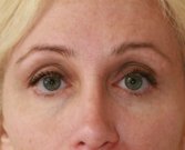 Eyelid Surgery San Diego Case 45 - before