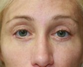 Eyelid Surgery San Diego Case 45 - after