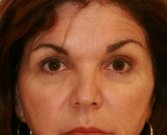 Eyelid Surgery San Diego Case 46 - before