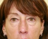 Eyelid Surgery San Diego Case 47 - before