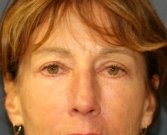 Eyelid Surgery San Diego Case 47 - after