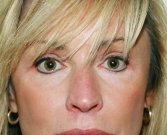 Eyelid Surgery San Diego Case 48 - before
