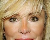Eyelid Surgery San Diego Case 48 - after