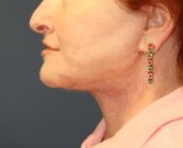 Necklift San Diego Case 19 - after