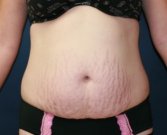 Tummy Tuck San Diego Case 33 - before