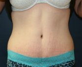 Tummy Tuck San Diego Case 33 - after