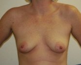 Breast Augmentation San Diego Case 55 - before