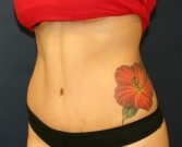 Tummy Tuck San Diego Case 34 - after