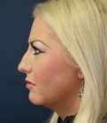 Rhinoplasty San Diego Case 29 - before