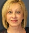 Facelift San Diego Case 18 - after