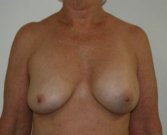 Breast Revision San Diego 5 - before