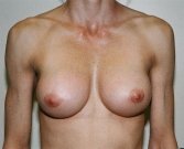 Breast Revision San Diego 6 - after
