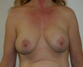 Breast Revision San Diego 17 - before
