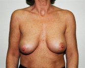 Breast Revision San Diego 18 - after