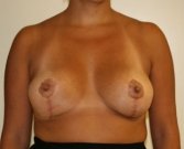 Breast Reduction San Diego 9 - after