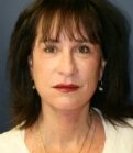 Facelift San Diego Case 20 - after
